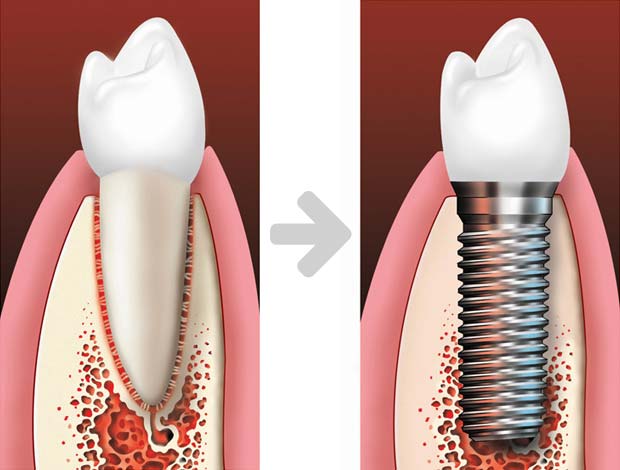 Single implant before-after
