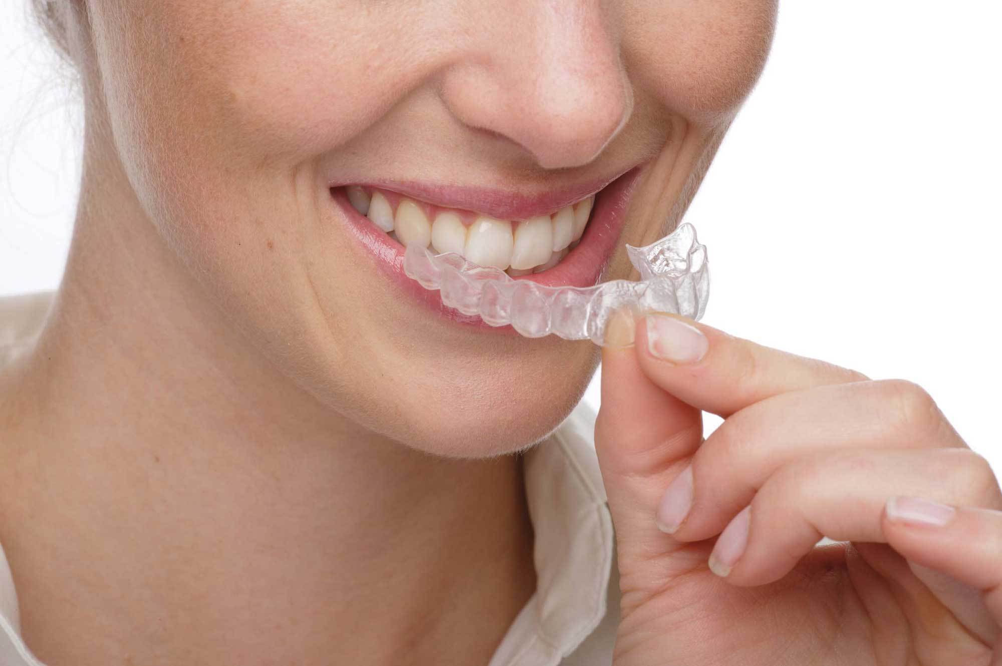 Invisalign clear tooth alignment system