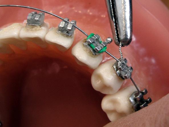 Brackets, or braces