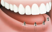 Bridge Implant