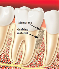 Periodontal Surgery Grafting