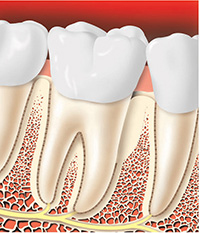 Periodontal Surgery Healed