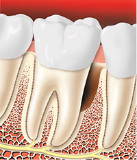 Periodontal Surgery Bone Reshaping