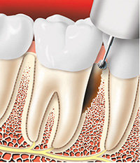 Periodontal Surgery Tissue Removal