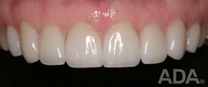 Veneers After